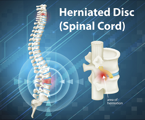 3D medical illustration of herniated disc