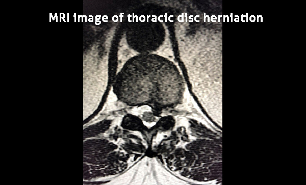 MRI image of thoracic disc herniation