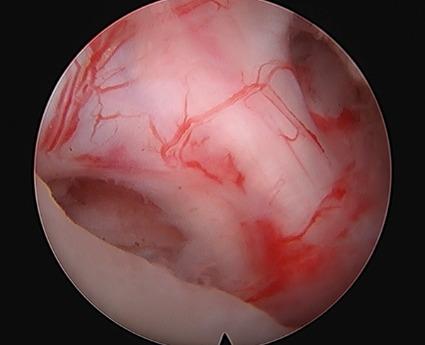 endoscopic view of decompressed cervical nerve root