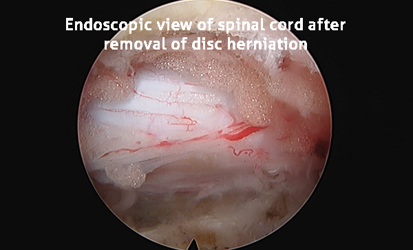 Endoscopic view of spinal cord after removal of disc herniation