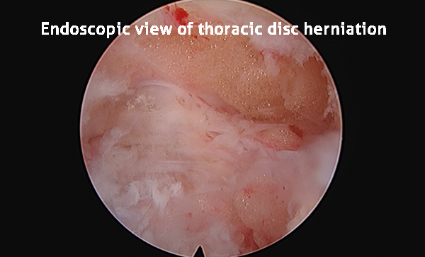 Endoscopic view of thoracic disc herniation
